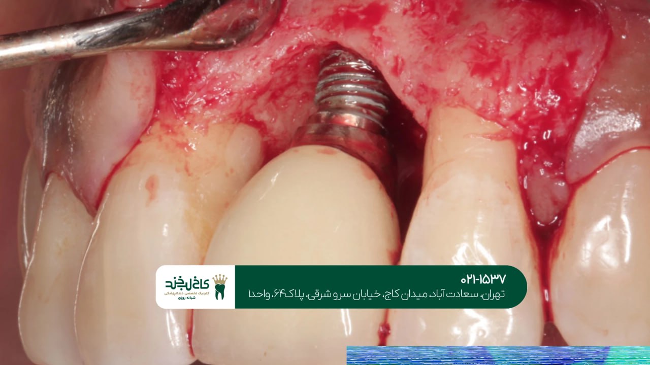 کاشت دندان اقساطی در تجریش کاشت دندان اقساطی در تجریش