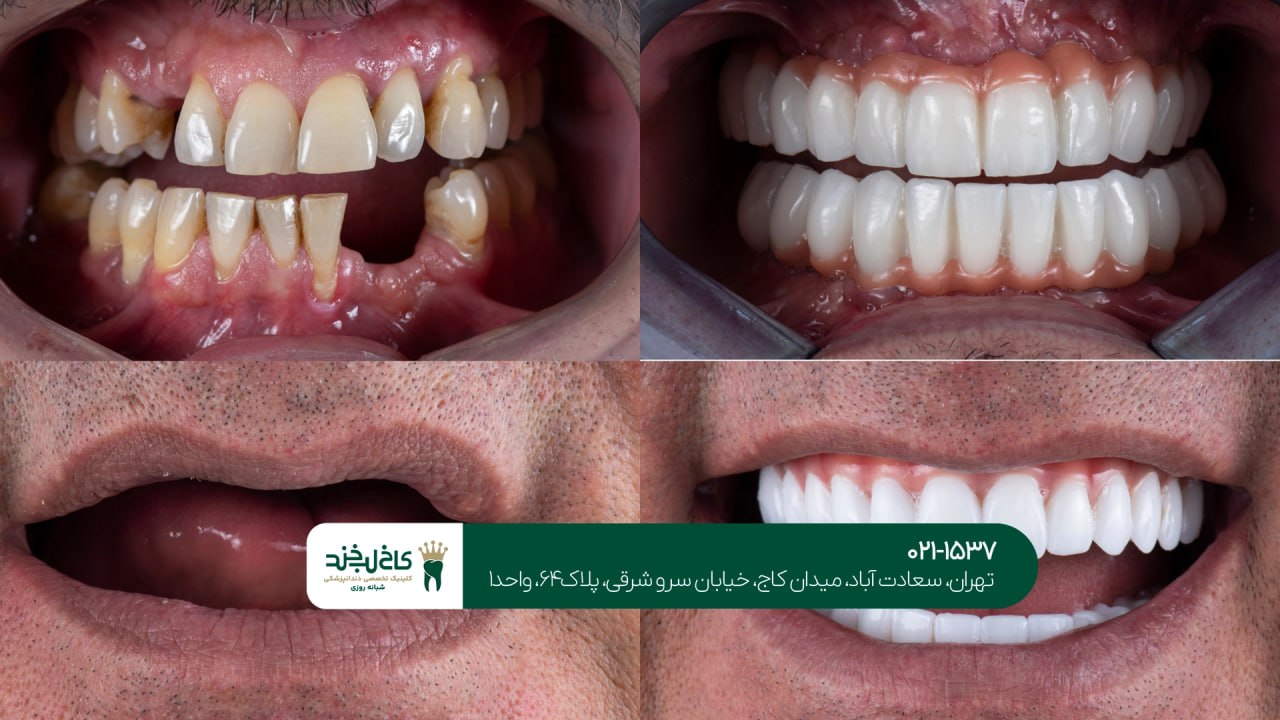 خدمات ایمپلنت فک بالا و پایین خدمات ایمپلنت فک بالا و پایین