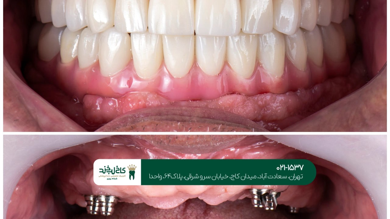 خدمات ایمپلنت فک بالا و پایین خدمات ایمپلنت فک بالا و پایین