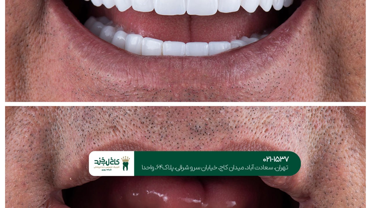 خدمات ایمپلنت فک بالا و پایین خدمات ایمپلنت فک بالا و پایین