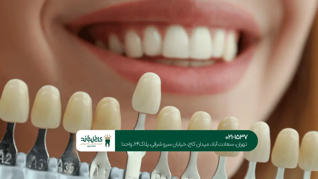 لمینت اقساطی در نیاوران لمینت اقساطی در نیاوران