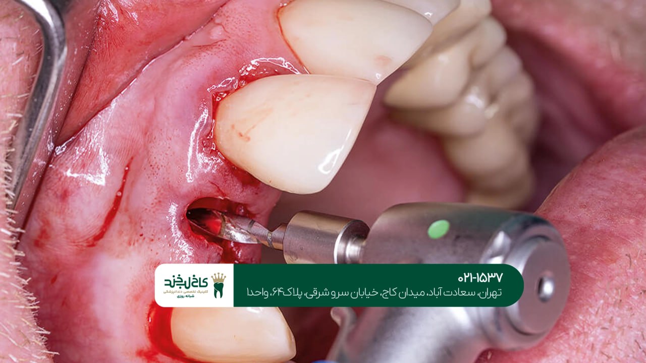 ایمپلنت اقساطی ویژه کارمندان ایمپلنت اقساطی ویژه کارمندان