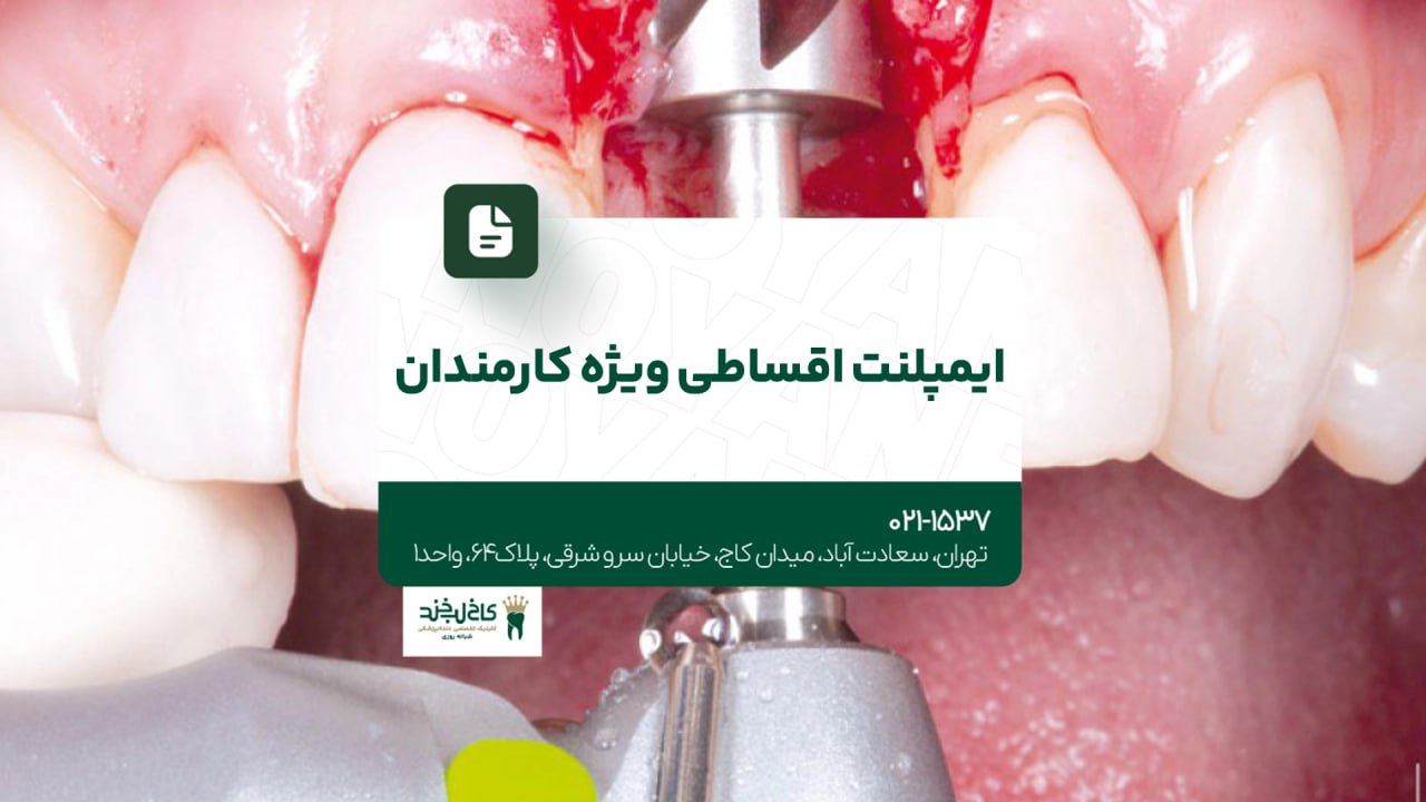 ایمپلنت اقساطی ویژه کارمندان ایمپلنت اقساطی ویژه کارمندان