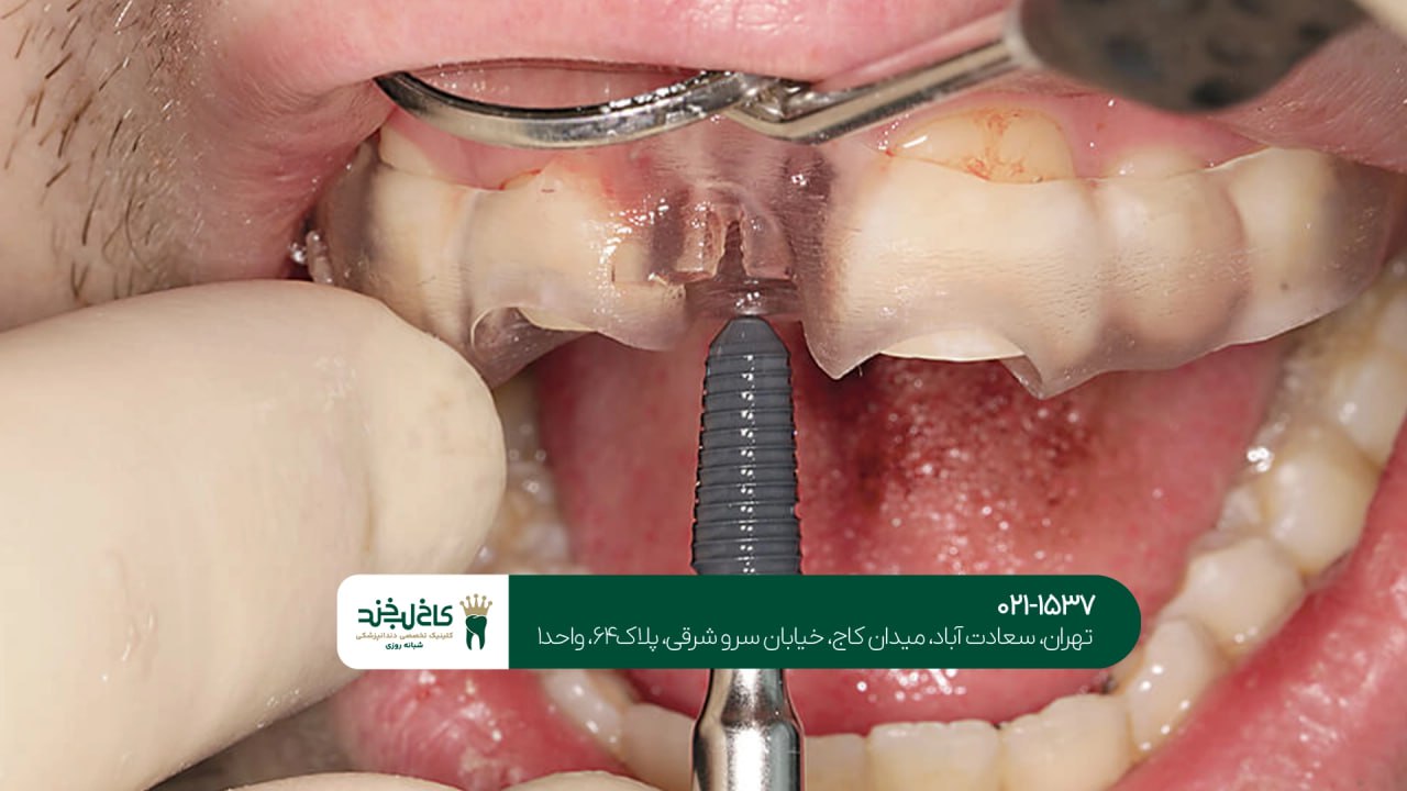 کاشت ایمپلنت اقساطی با ضمانت کاشت ایمپلنت اقساطی با ضمانت