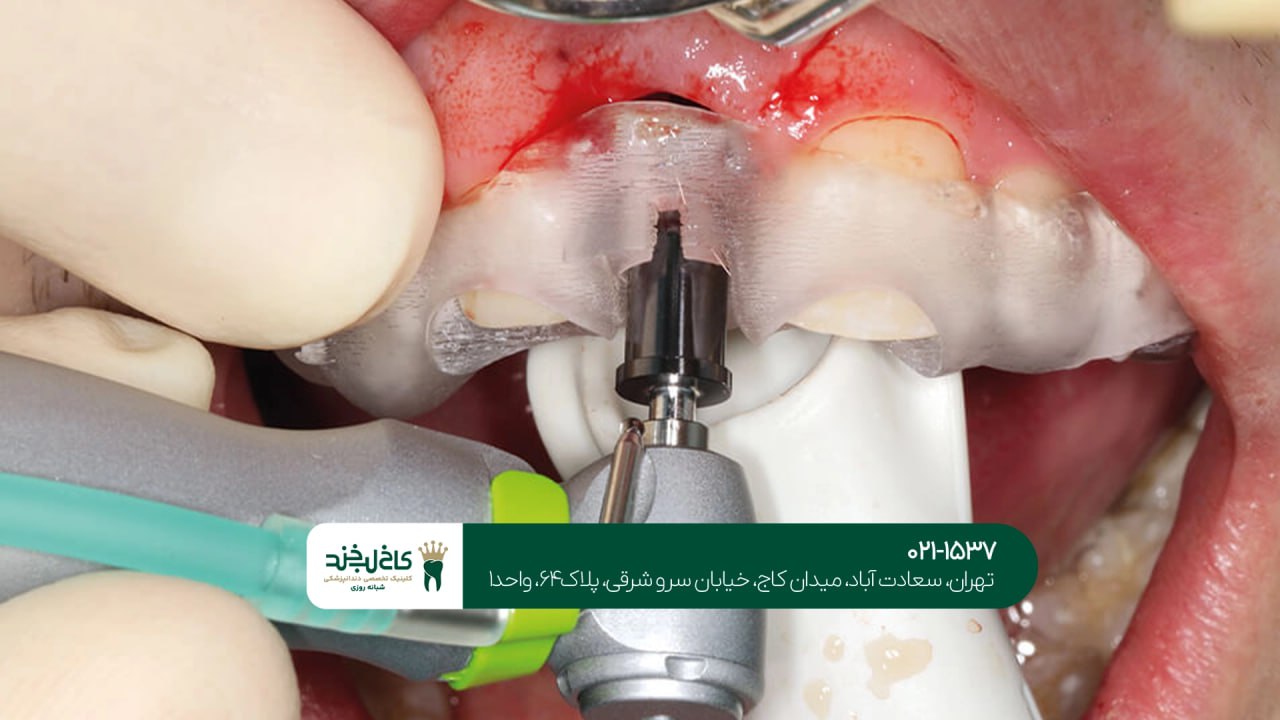 کاشت ایمپلنت اقساطی با ضمانت کاشت ایمپلنت اقساطی با ضمانت