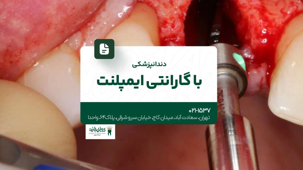 دندانپزشکی با گارانتی ایمپلنت دندانپزشکی با گارانتی ایمپلنت