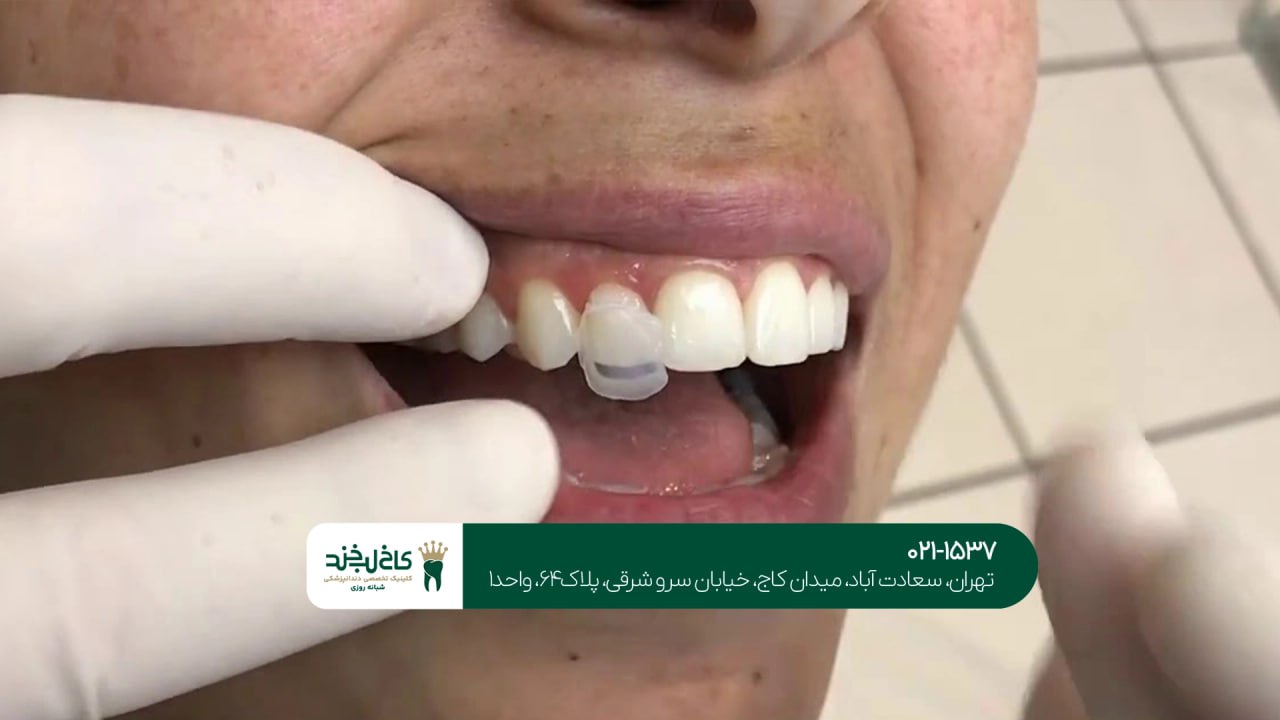 لمینت دندان با ضمانت بلندمدت لمینت دندان با ضمانت بلندمدت