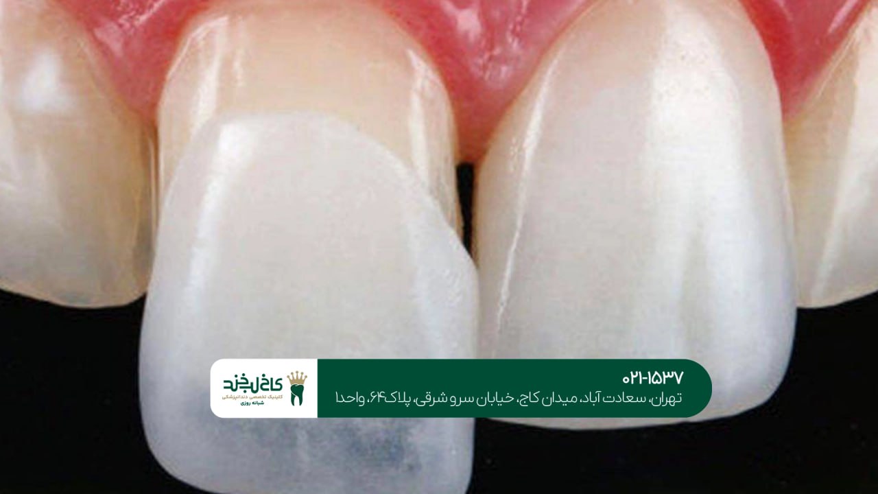 لمینت دندان با ضمانت بلندمدت لمینت دندان با ضمانت بلندمدت