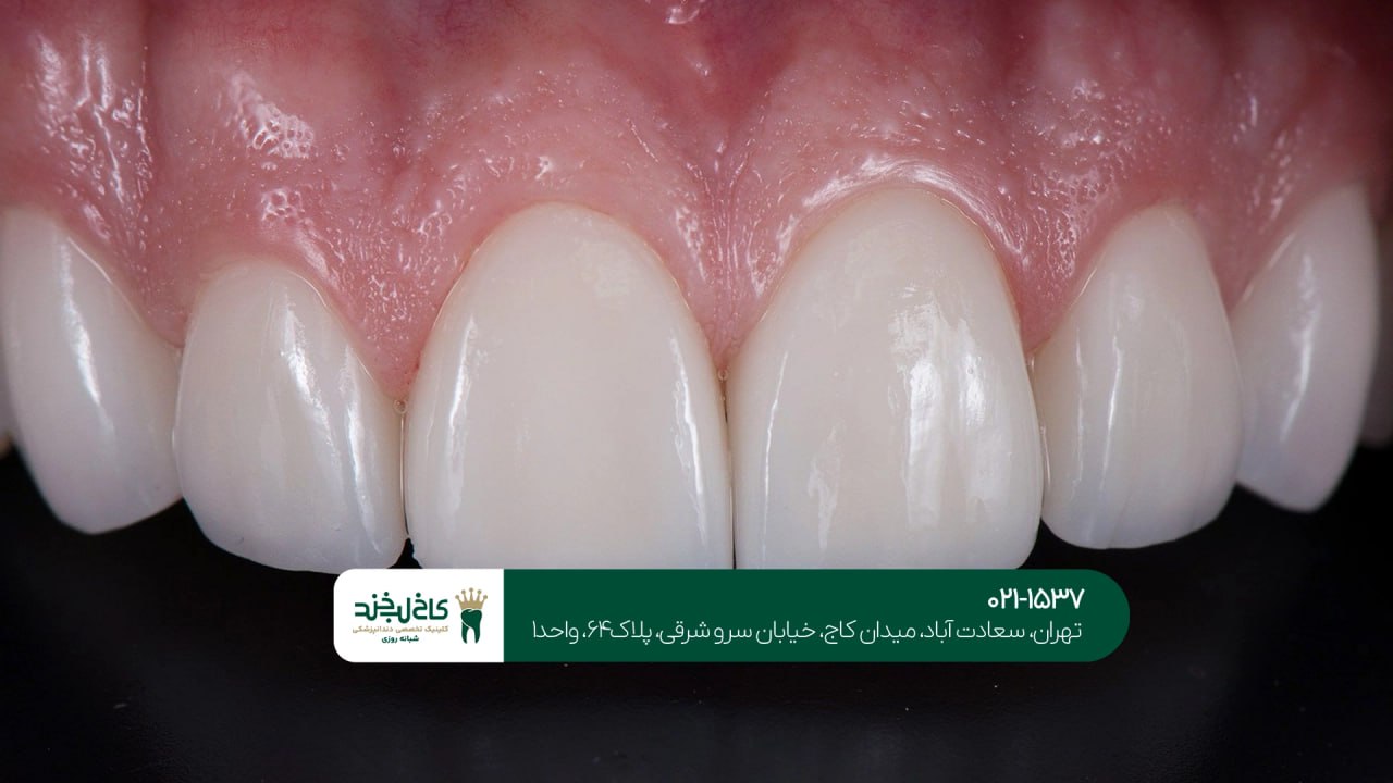 لمینت دندان با ضمانت بلندمدت لمینت دندان با ضمانت بلندمدت