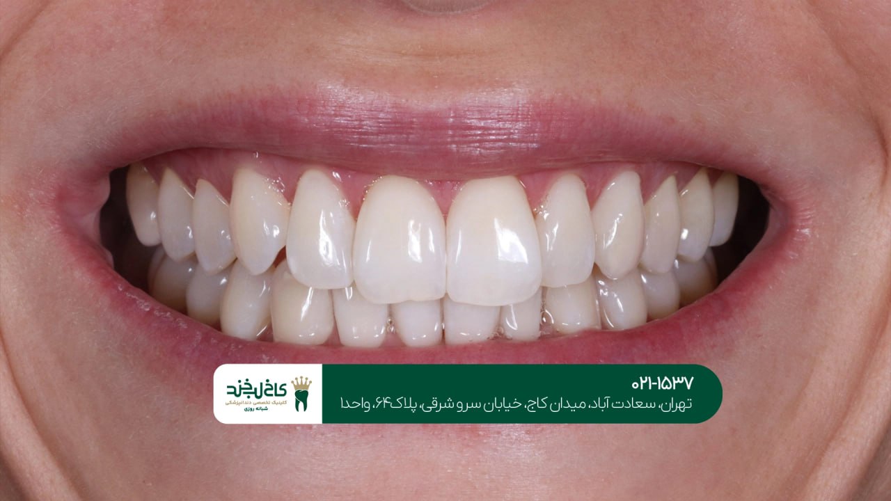 کامپوزیت دندان با گارانتی رنگ کامپوزیت دندان با گارانتی رنگ