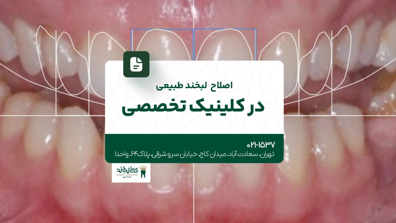 اصلاح لبخند طبیعی در کلینیک تخصصی اصلاح لبخند طبیعی در کلینیک تخصصی