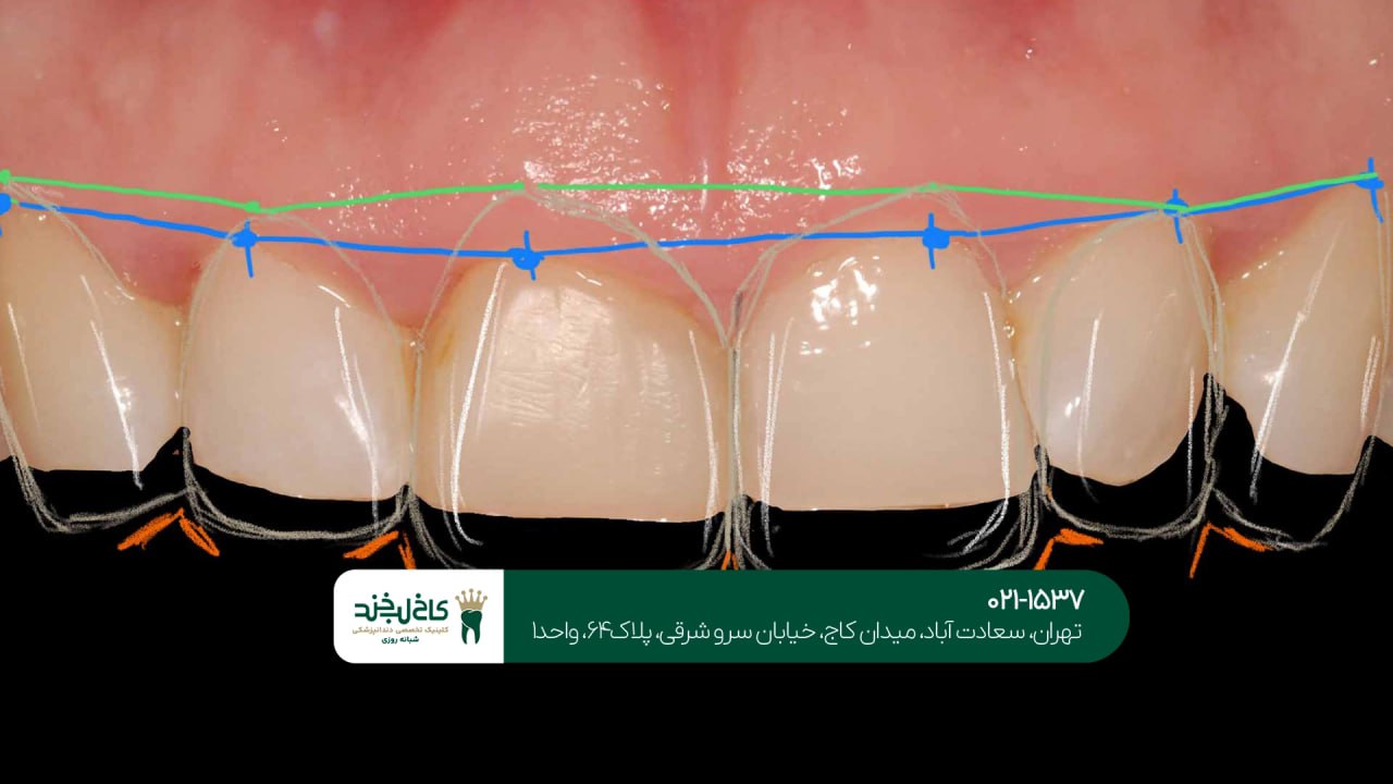 اصلاح لبخند طبیعی در کلینیک تخصصی اصلاح لبخند طبیعی در کلینیک تخصصی