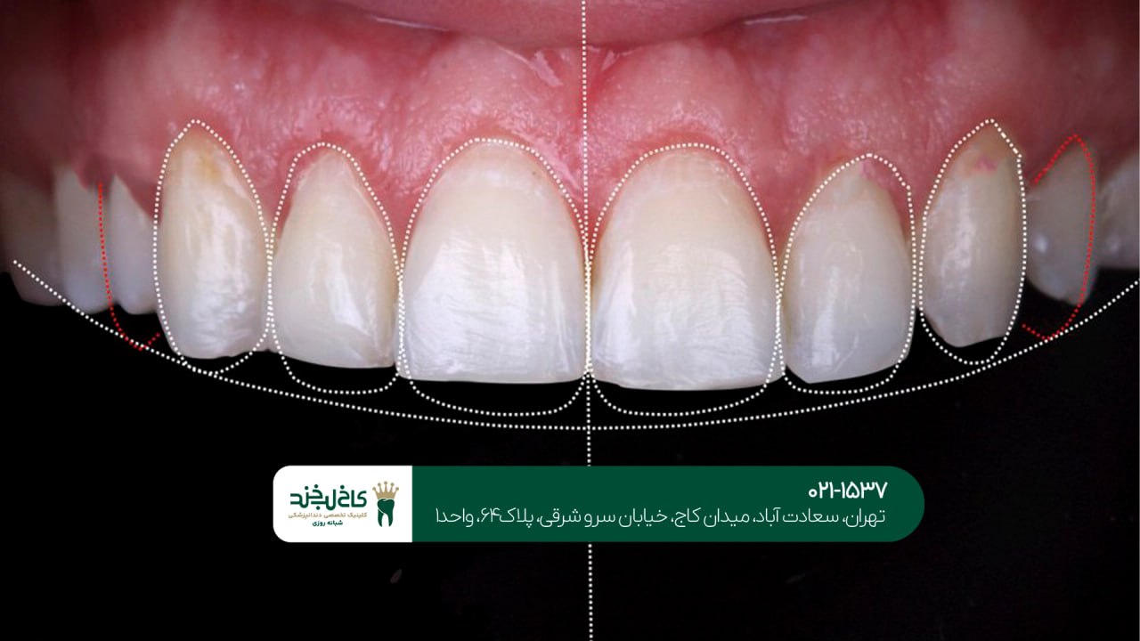 اصلاح لبخند طبیعی در کلینیک تخصصی اصلاح لبخند طبیعی در کلینیک تخصصی