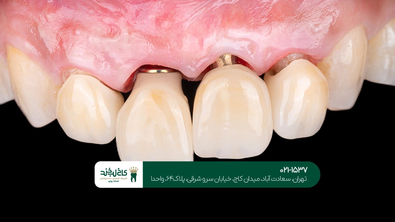 بهترین مرکز ایمپلنت یک روزه اقساطی بهترین مرکز ایمپلنت یک روزه اقساطی