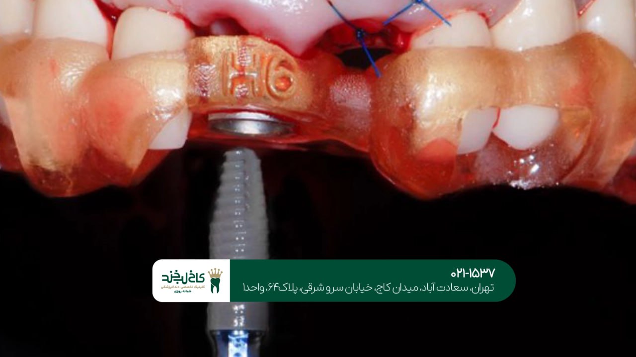 بهترین مرکز ایمپلنت یک روزه اقساطی بهترین مرکز ایمپلنت یک روزه اقساطی