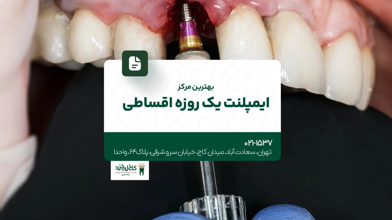 بهترین مرکز ایمپلنت یک روزه اقساطی بهترین مرکز ایمپلنت یک روزه اقساطی