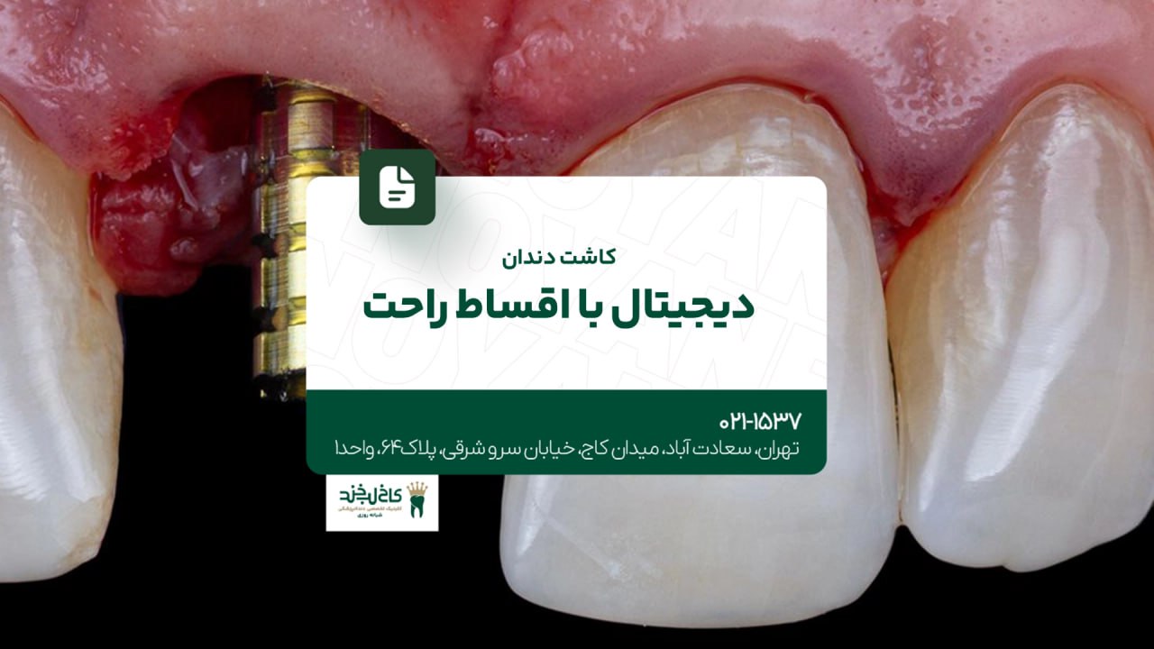 کاشت دندان دیجیتال با اقساط راحت کاشت دندان دیجیتال با اقساط راحت