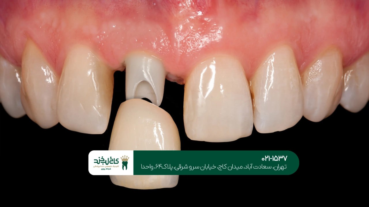 کاشت دندان دیجیتال با اقساط راحت کاشت دندان دیجیتال با اقساط راحت