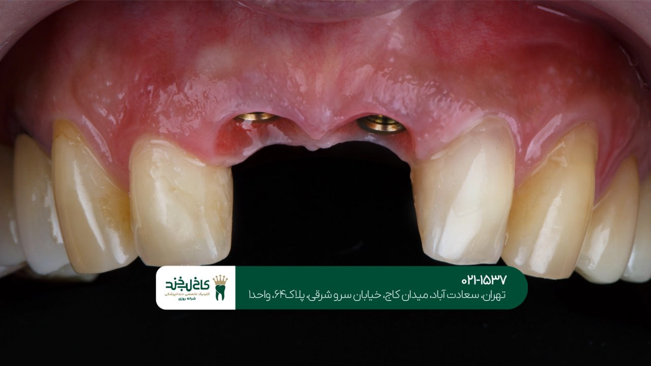 کاشت دندان دیجیتال با اقساط راحت کاشت دندان دیجیتال با اقساط راحت