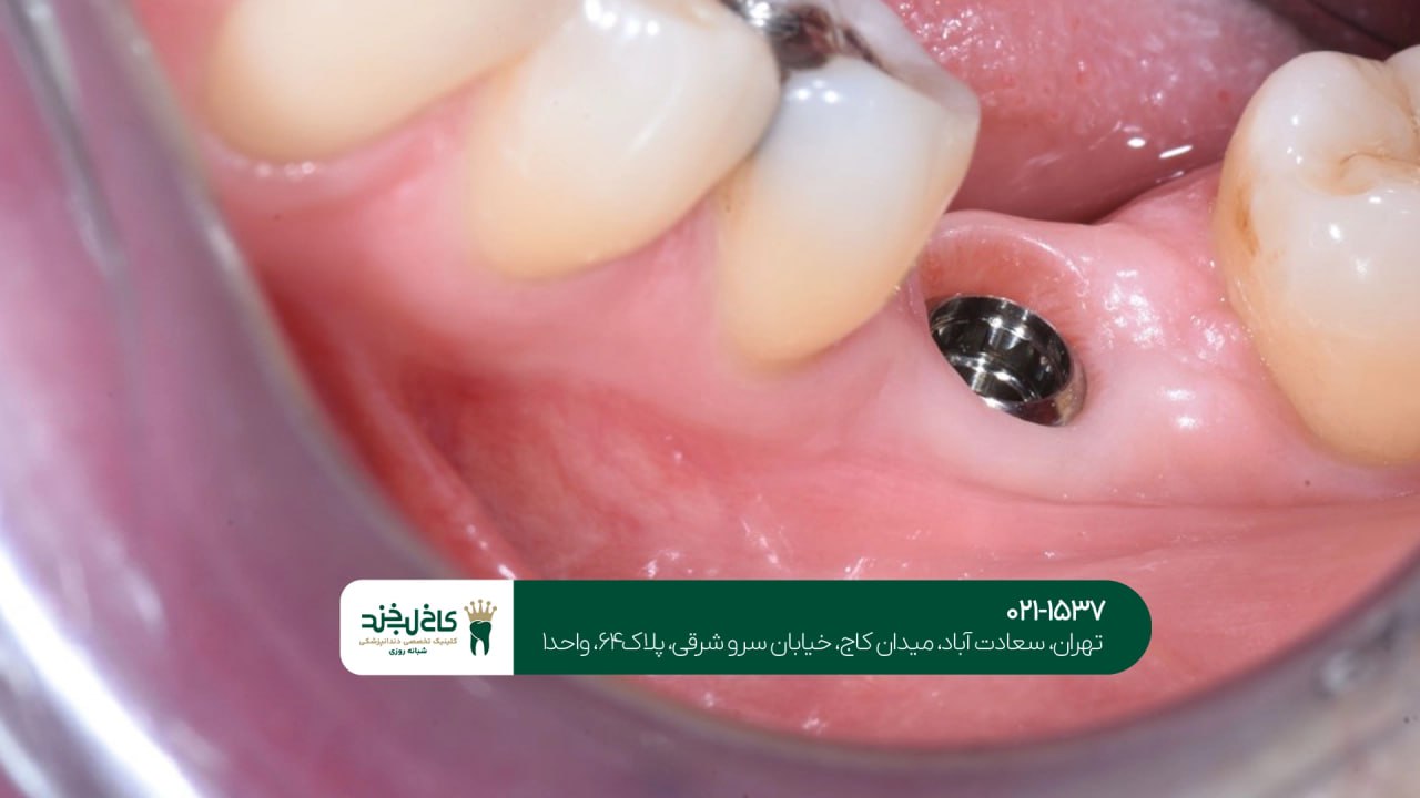 مشاوره تخصصی و رایگان ایمپلنت مشاوره تخصصی و رایگان ایمپلنت