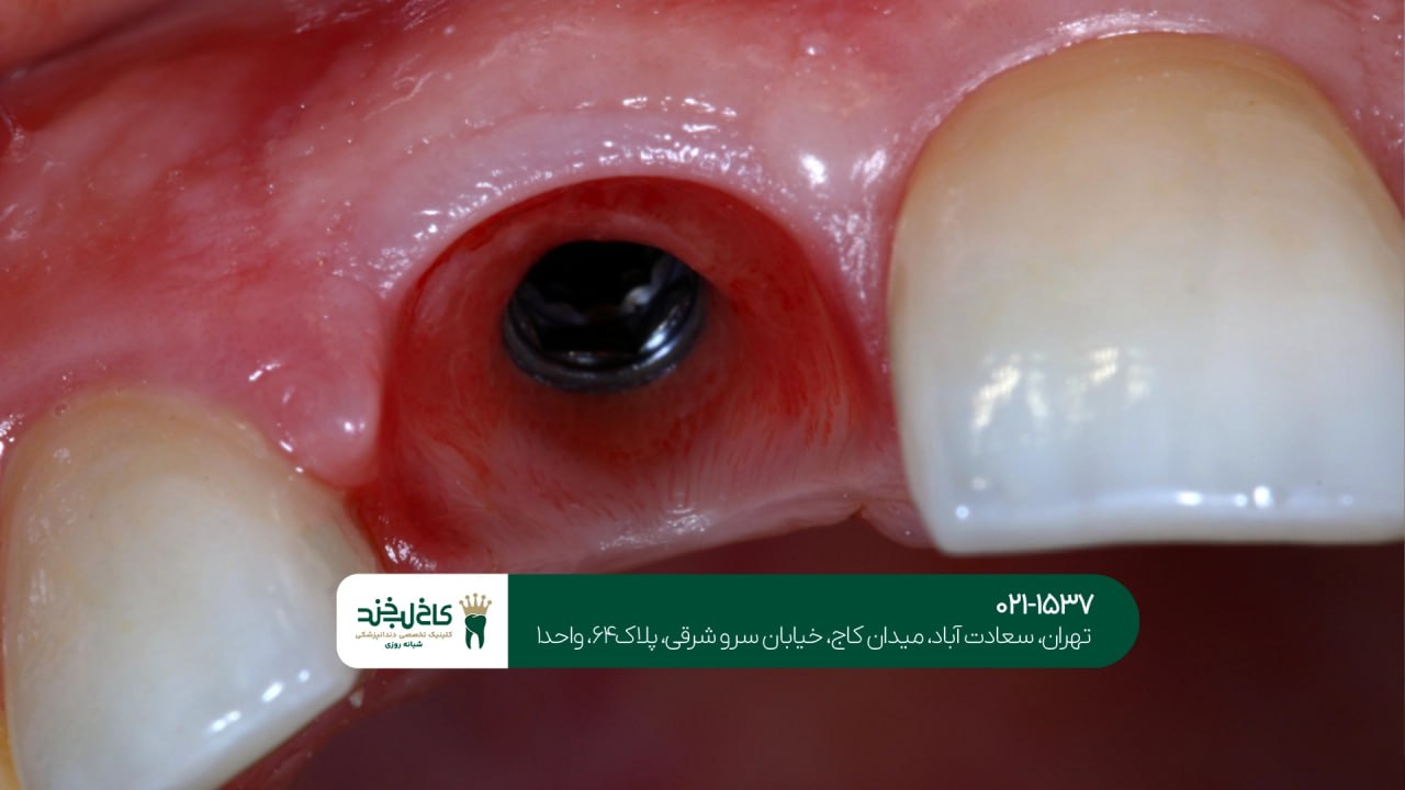مشاوره تخصصی و رایگان ایمپلنت مشاوره تخصصی و رایگان ایمپلنت