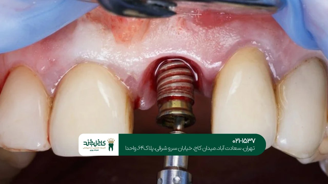 مشاوره تخصصی و رایگان ایمپلنت مشاوره تخصصی و رایگان ایمپلنت