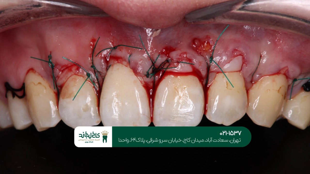 جراحی زیبایی لثه اقساطی در تهران جراحی زیبایی لثه اقساطی در تهران