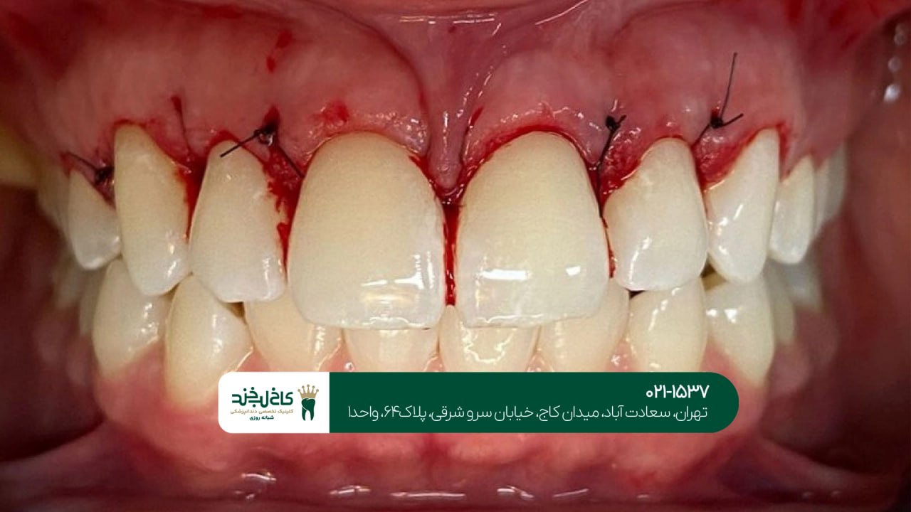 جراحی زیبایی لثه اقساطی در تهران جراحی زیبایی لثه اقساطی در تهران