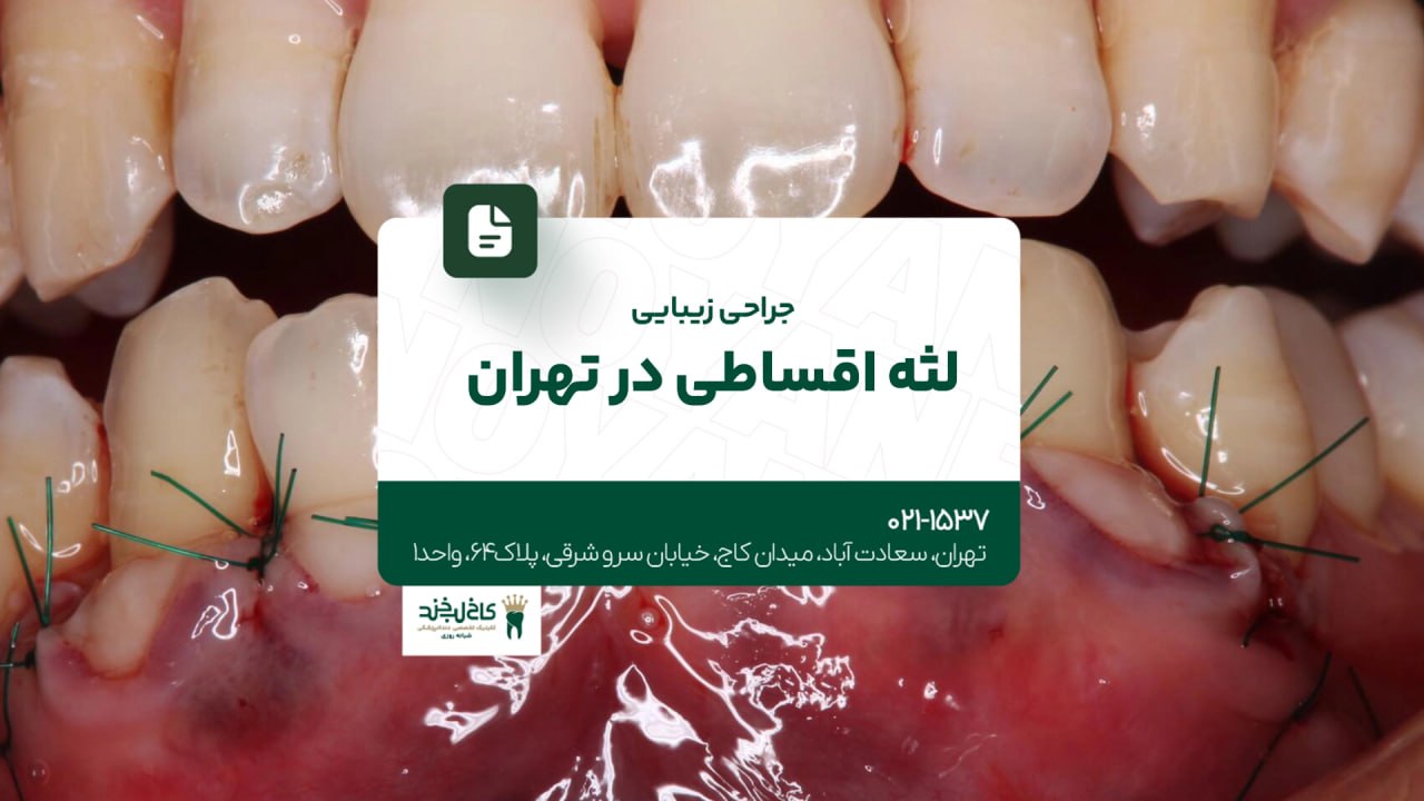 جراحی زیبایی لثه اقساطی در تهران جراحی زیبایی لثه اقساطی در تهران