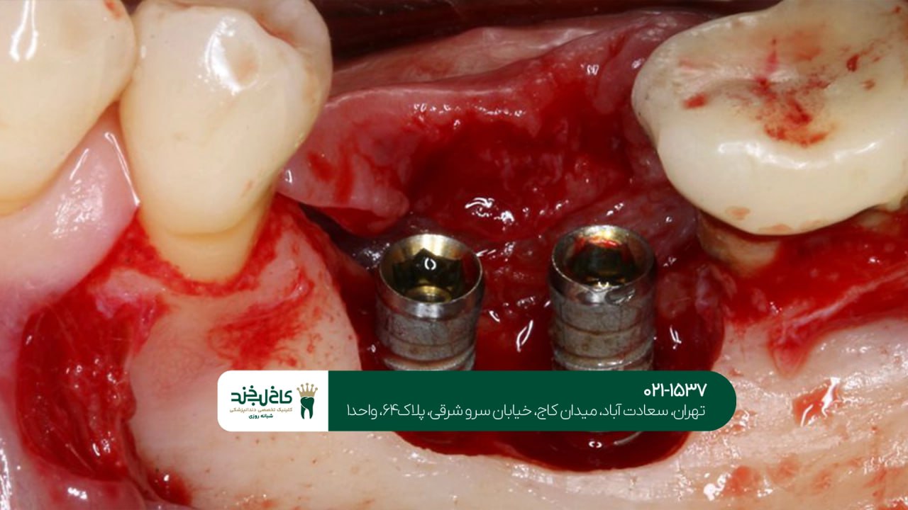 ایمپلنت دیجیتال اقساطی با کیفیت عالی ایمپلنت دیجیتال اقساطی با کیفیت عالی