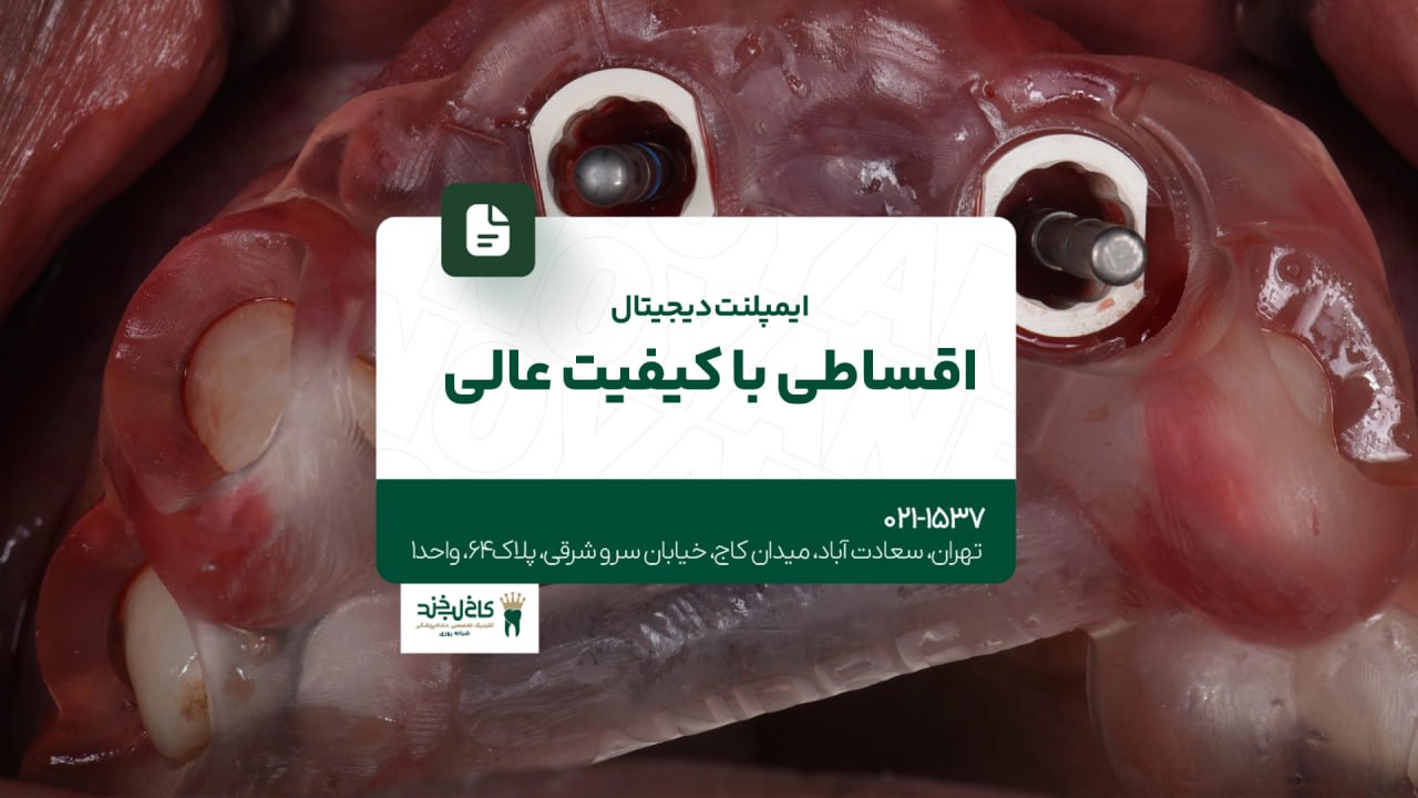 ایمپلنت دیجیتال اقساطی با کیفیت عالی ایمپلنت دیجیتال اقساطی با کیفیت عالی