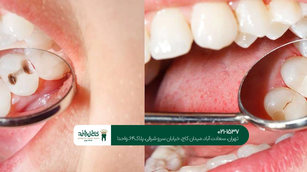 ترمیم دندان اقساطی در کلینیک تخصصی ترمیم دندان اقساطی در کلینیک تخصصی