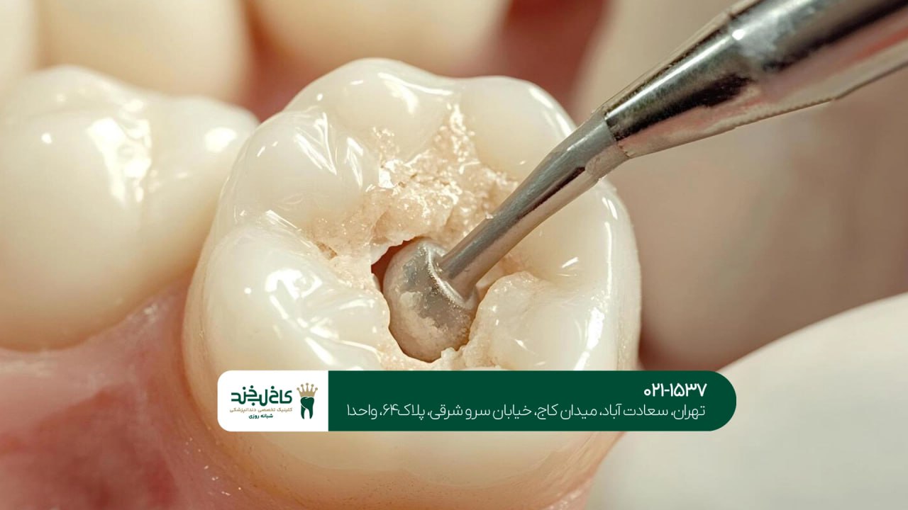 ترمیم دندان اقساطی در کلینیک تخصصی ترمیم دندان اقساطی در کلینیک تخصصی