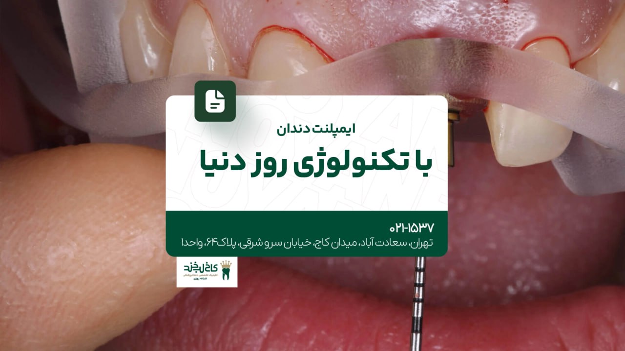 ایمپلنت دندان با تکنولوژی روز دنیا ایمپلنت دندان با تکنولوژی روز دنیا