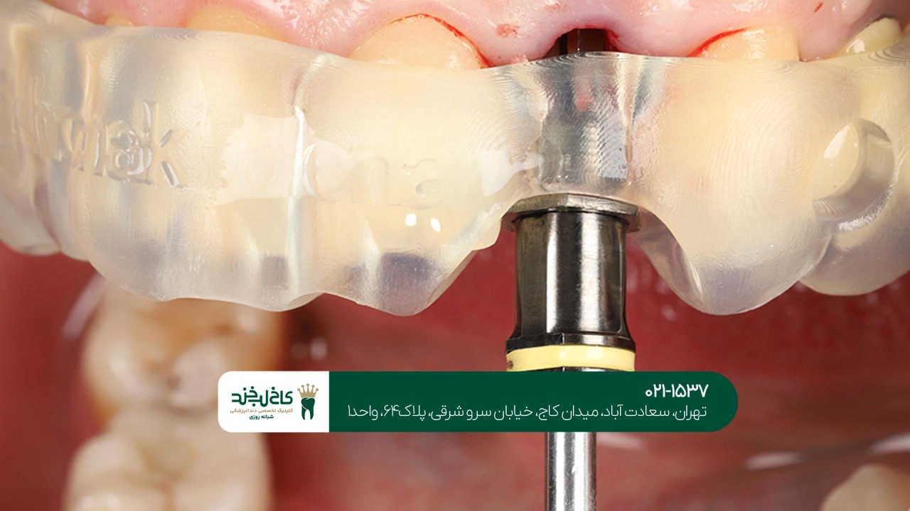 ایمپلنت دندان با تکنولوژی روز دنیا ایمپلنت دندان با تکنولوژی روز دنیا