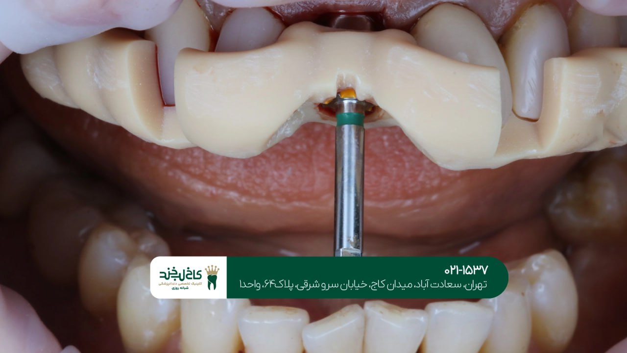 ایمپلنت دندان با تکنولوژی روز دنیا ایمپلنت دندان با تکنولوژی روز دنیا