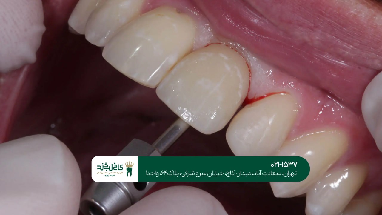 ایمپلنت دندان با تکنولوژی روز دنیا ایمپلنت دندان با تکنولوژی روز دنیا