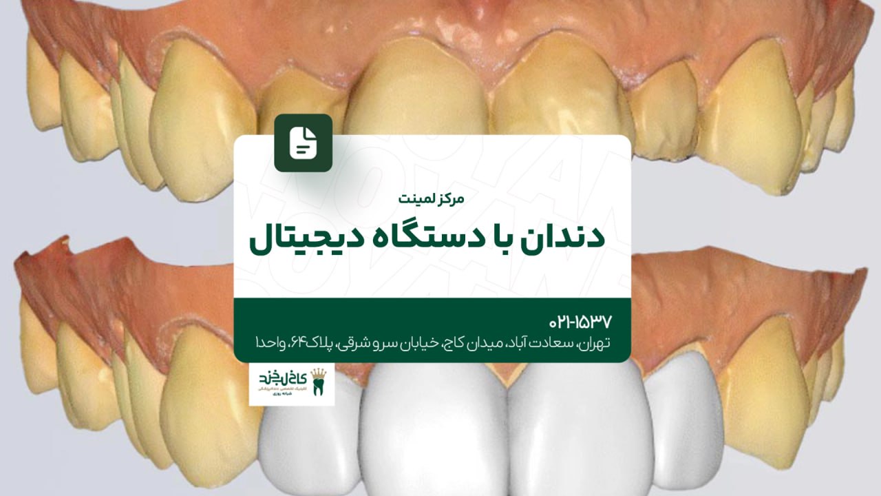 مرکز لمینت دندان با دستگاه دیجیتال مرکز لمینت دندان با دستگاه دیجیتال