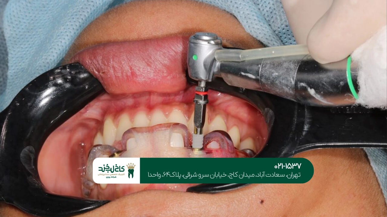 کاشت دندان با دستگاه سه بعدی کاشت دندان با دستگاه سه بعدی