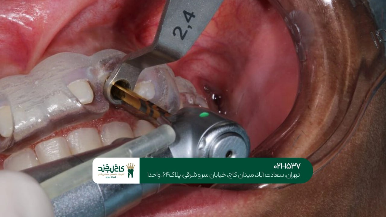 کاشت دندان با دستگاه سه بعدی کاشت دندان با دستگاه سه بعدی