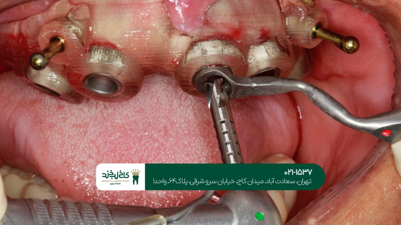 کاشت دندان با دستگاه سه بعدی کاشت دندان با دستگاه سه بعدی