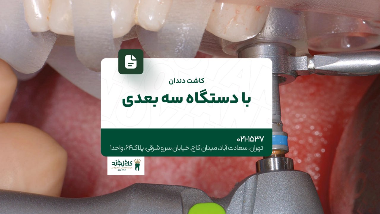 کاشت دندان با دستگاه سه بعدی کاشت دندان با دستگاه سه بعدی