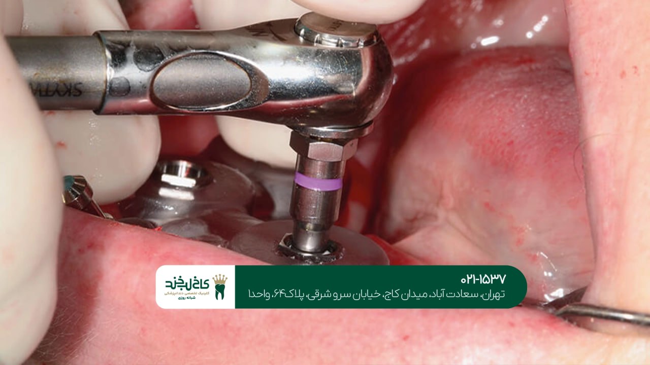کلینیک تخصصی ایمپلنت دیجیتال شمال تهران کلینیک تخصصی ایمپلنت دیجیتال شمال تهران