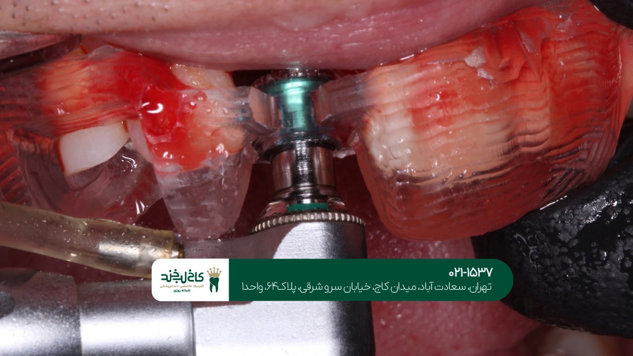 کلینیک تخصصی ایمپلنت دیجیتال شمال تهران کلینیک تخصصی ایمپلنت دیجیتال شمال تهران