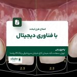 اصلاح طرح لبخند با فناوری دیجیتال
