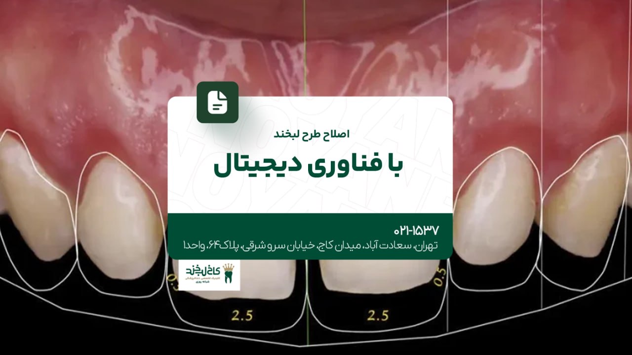 اصلاح طرح لبخند با فناوری دیجیتال اصلاح طرح لبخند با فناوری دیجیتال