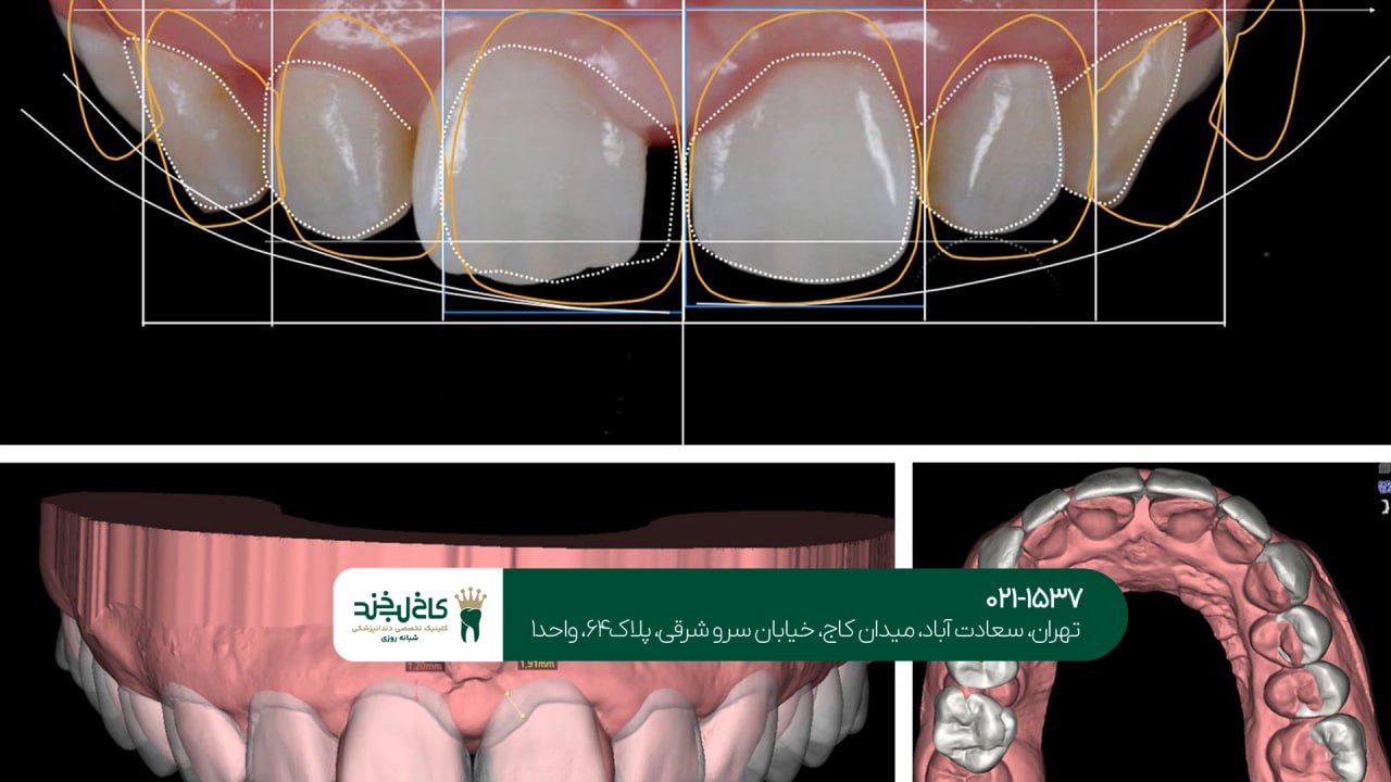 اصلاح طرح لبخند با فناوری دیجیتال اصلاح طرح لبخند با فناوری دیجیتال