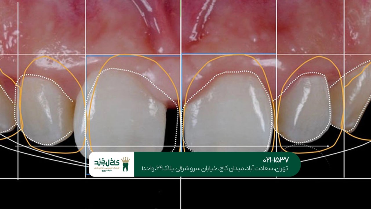 اصلاح طرح لبخند با فناوری دیجیتال اصلاح طرح لبخند با فناوری دیجیتال