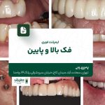 ایمپلنت فوری فک بالا و پایین