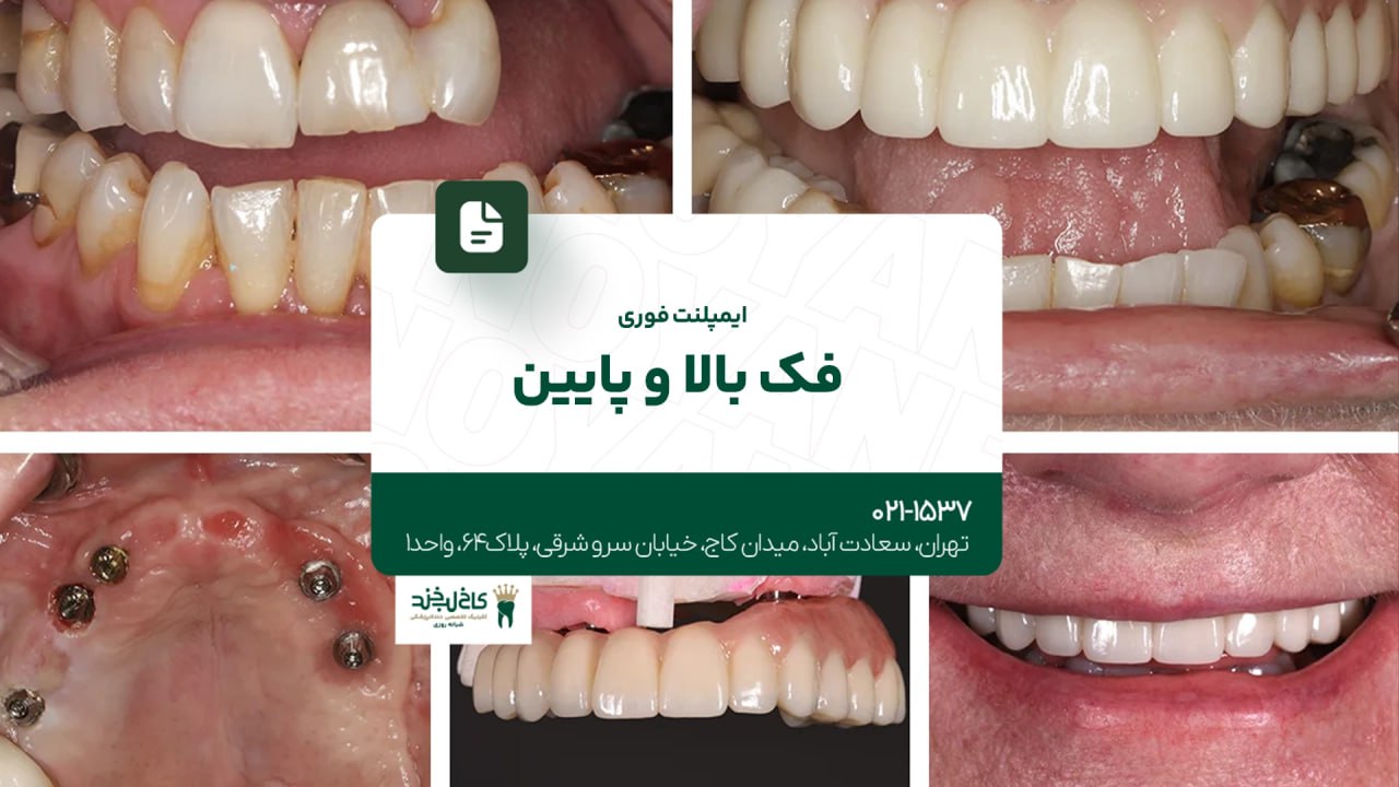 ایمپلنت فوری فک بالا و پایین ایمپلنت فوری فک بالا و پایین